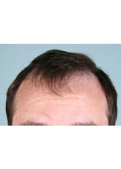 Before Hair Transplant&nbsp;Hairlines