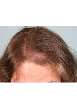 Before Hair Transplant&nbsp;Hair Thinning
