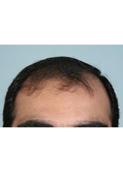 Before Hair Transplant&nbsp;Front
