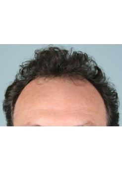 Before Hair Transplant&nbsp;Temporal Hairline