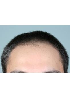 Before Hair Transplant&nbsp;Front