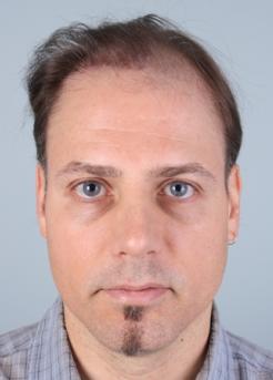 Before Hair Transplant&nbsp;Revision