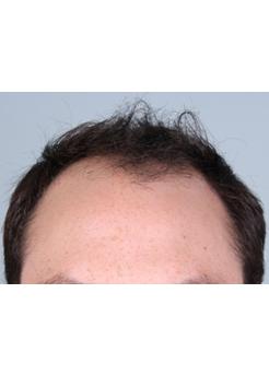 Before Hair Transplant&nbsp;Front
