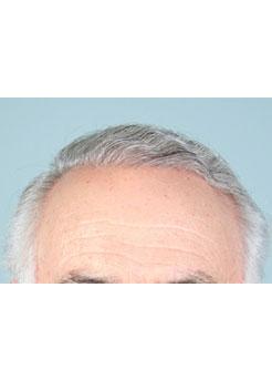 Before Hair Transplant&nbsp;Hairlines