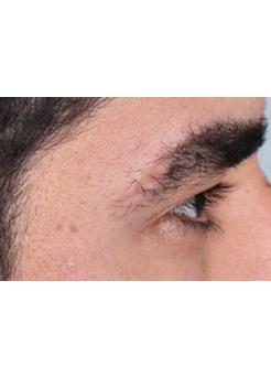 Before Hair Transplant&nbsp;Eyebrows