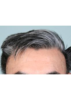 Before Hair Transplant&nbsp;Temporal Hairline
