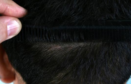 Hair Transplant&nbsp;Trichophytic Donor Scars
