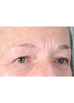 Before Hair Transplant&nbsp;Eyebrows