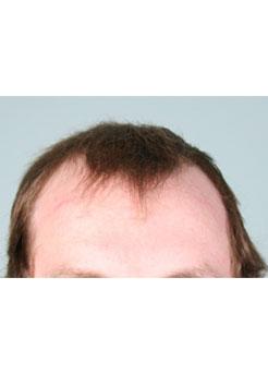 Before Hair Transplant&nbsp;Hairlines