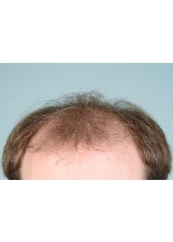 Before Hair Transplant&nbsp;Front