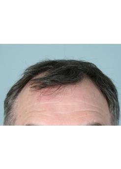 Before Hair Transplant&nbsp;Front