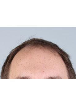 Before Hair Transplant&nbsp;Front