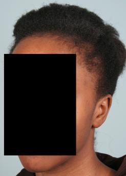 Before Hair Transplant&nbsp;Traction Alopecia