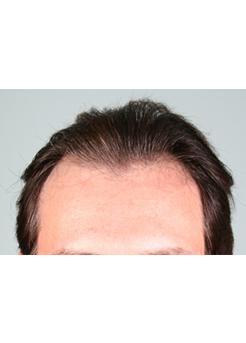 Before Hair Transplant&nbsp;Front