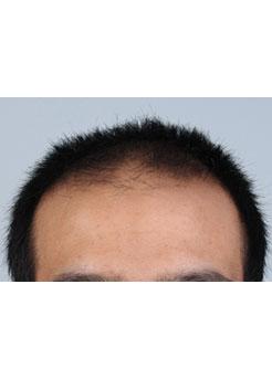 Before Hair Transplant&nbsp;Front