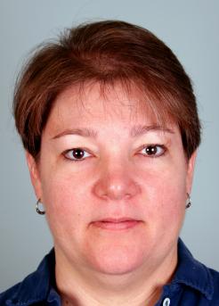 Before Hair Transplant&nbsp;Hair Thinning
