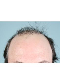 Before Hair Transplant&nbsp;Revision