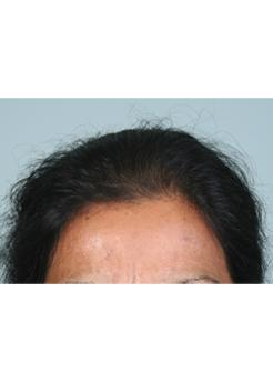 Before Hair Transplant&nbsp;Hair Thinning
