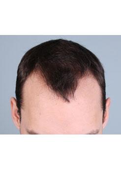 Before Hair Transplant&nbsp;Hairlines