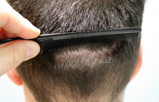 Hair Transplant&nbsp;Trichophytic Donor Scars
