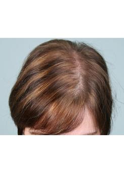 Before Hair Transplant&nbsp;Hair Thinning