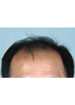 Before Hair Transplant&nbsp;2 Sessions (Areas)