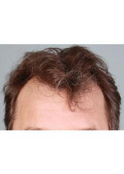 Before Hair Transplant&nbsp;Hairlines