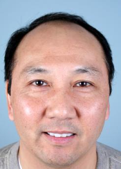 Before Hair Transplant&nbsp;Front
