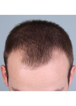 Before Hair Transplant&nbsp;Front