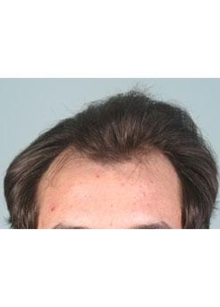 Before Hair Transplant&nbsp;Hairlines