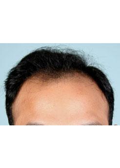 Before Hair Transplant&nbsp;Hairlines
