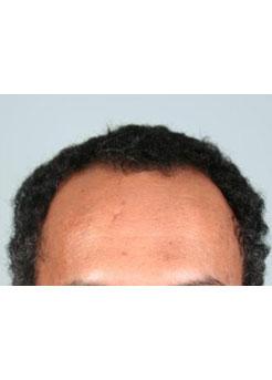 Before Hair Transplant&nbsp;Hairlines