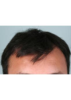 Before Hair Transplant&nbsp;Front