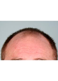 Before Hair Transplant&nbsp;Front