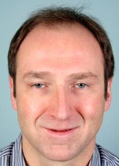 Before Hair Transplant&nbsp;Front