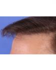 After Hair Transplant&nbsp;Revision