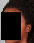After Hair Transplant &nbsp;Traction Alopecia