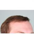After Hair Transplant&nbsp;Hairlines
