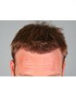 After Hair Transplant&nbsp;Hairlines