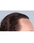 After Hair Transplant&nbsp;Temporal Hairline