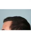 After Hair Transplant&nbsp;Hairlines