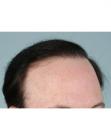 After Hair Transplant&nbsp;Revision