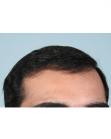 After Hair Transplant&nbsp;Front