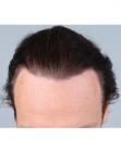After Hair Transplant&nbsp;Temporal Hairline