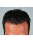 After Hair Transplant&nbsp;Hairlines