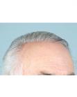 After Hair Transplant&nbsp;Hairlines