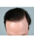 After Hair Transplant&nbsp;Revision