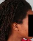 After Hair Transplant&nbsp;Traction Alopecia