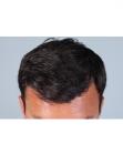 After Hair Transplant&nbsp;Front