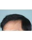 After Hair Transplant&nbsp;2 Sessions (Areas)
